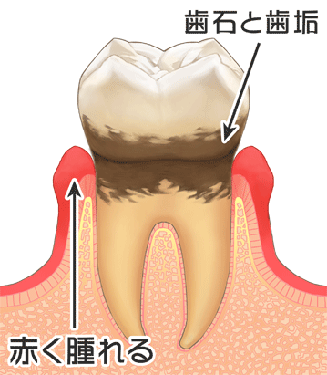 軽度歯周炎