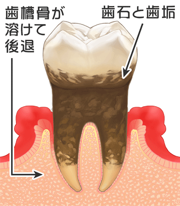 中等度歯周炎